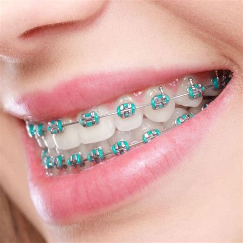 precio ortodoncia brackets metalicos|can braces damage your teeth.